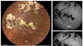 Diagnosis of rare eye diseases: Uveitis experts provide an overview of an underestimated imaging technique