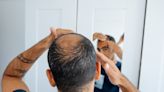 Men on hair-loss drug warned of sexual and psychiatric side effects