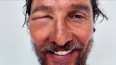 Matthew McConaughey’s face horrifically swollen by bee sting