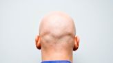 Scientists find potential ‘cure’ for baldness