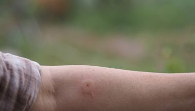 How to Treat a Wasp Sting