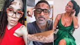 5 People with Vitiligo Open Up About What They Would Want Parents of Kids with the Skin Condition to Know