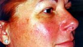 Have red patches on your face? Here are four potential causes of rosacea