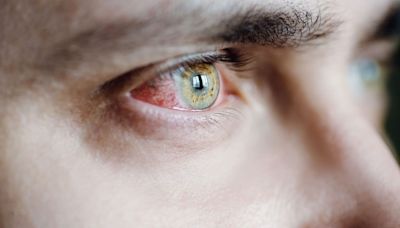 What Is Eye Syphilis? The Severe Symptom Doctors Are Seeing amid the STD Epidemic