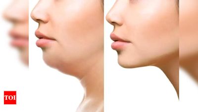 Is jawline correction surgery right choice for you? Expert opinions from Gurgaon doctors | Gurgaon News - Times of India