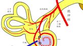 〈陳建志醫師專欄〉感冒後充斥打鼓聲… 竟是遠端段耳蝸管動脈狹窄