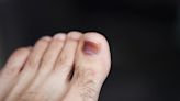 「凍甲」痛到走路有困難 樂生醫：這樣剪指甲可預防 | 蕃新聞