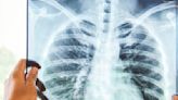 Recce Pharmaceuticals makes breakthrough in lung infection treatment with nebulised RECCE® 327