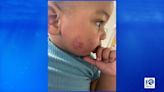 Norfolk mom removes toddler from daycare after five bite marks