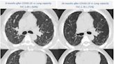 Lung complications can worsen two years after hospitalization for severe COVID-19