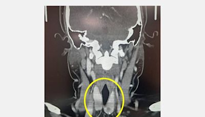 當心！ 兒童及青少年也有甲狀腺癌