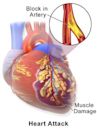 Myocardial infarction