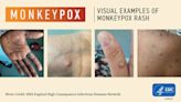 Who can get monkeypox vaccine in Kansas City? More people qualify, but supply is limited