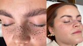 The rise of the fake freckle: Tattooist's warning after facial ink goes wrong