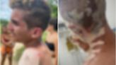 Jovem é queimado com óleo quente após briga no CE; vítima cita homofobia