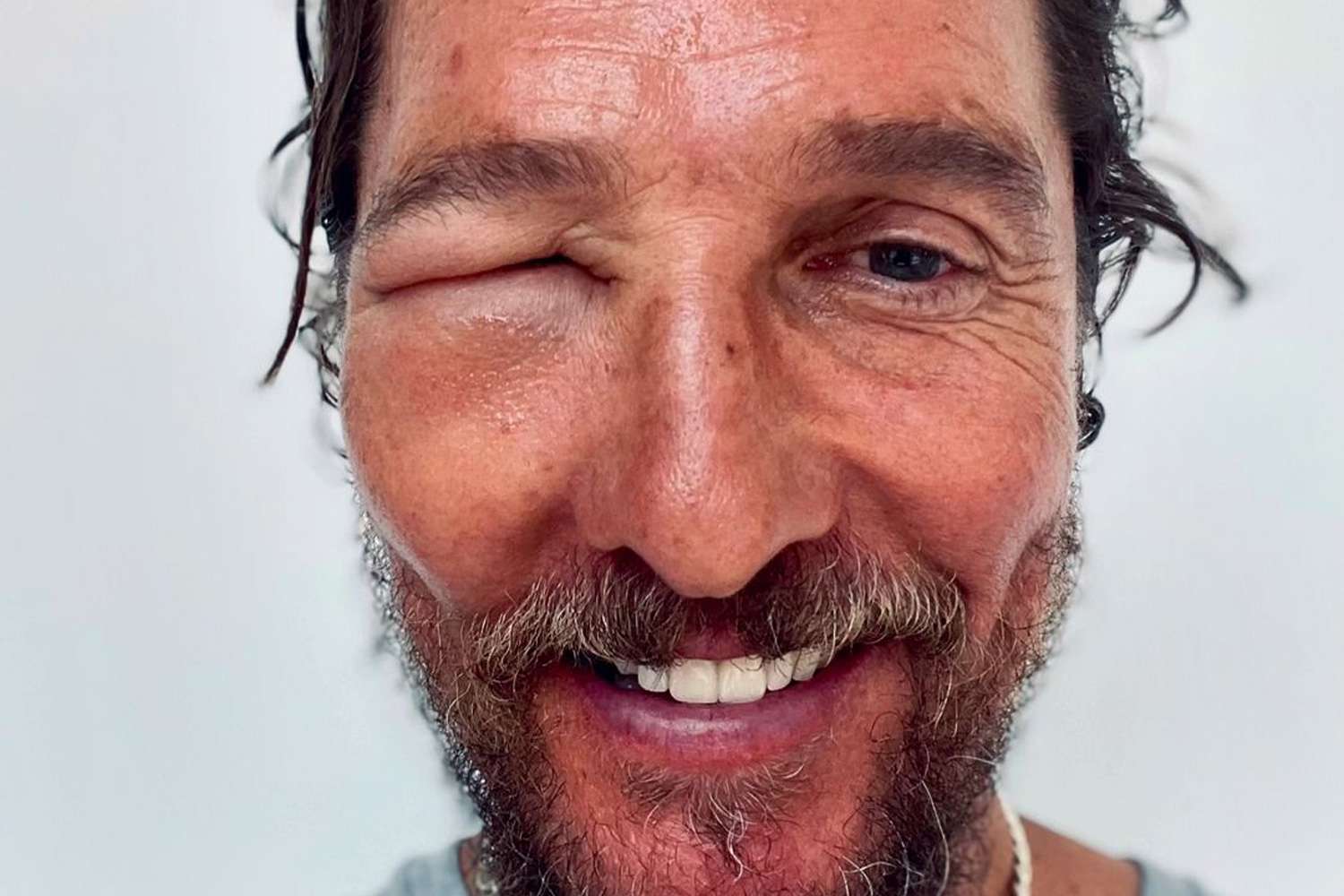 Matthew McConaughey Shocks Fans with His Swollen Eye: 'Bee Swell'