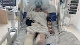 Banker on bike trip needed to have 'dead' leg amputated after crash