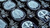 Los cerebros de algunas personas son resistentes al Alzheimer: la ciencia explica por qué