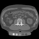 Quantitative computed tomography