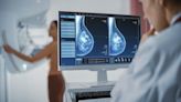 Finalized guidance drops breast cancer screening age to 40 for women with average risk