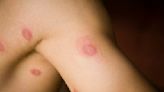 How Long Is Ringworm Contagious?