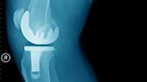 Arthroscopy Doesn't Delay Total Knee Replacement in OA