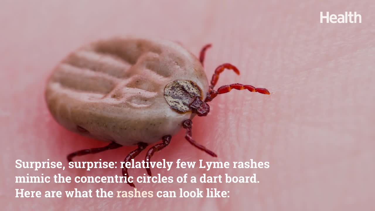 What Does a Lyme Disease Rash Really Look Like? These Pictures Explain It