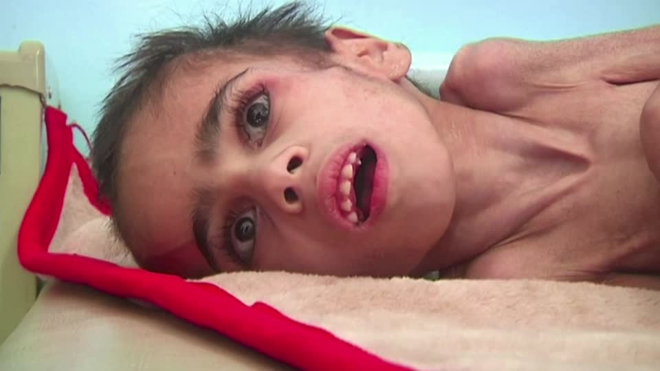 Yemeni Boy Ravaged By Hunger Weighs Lb