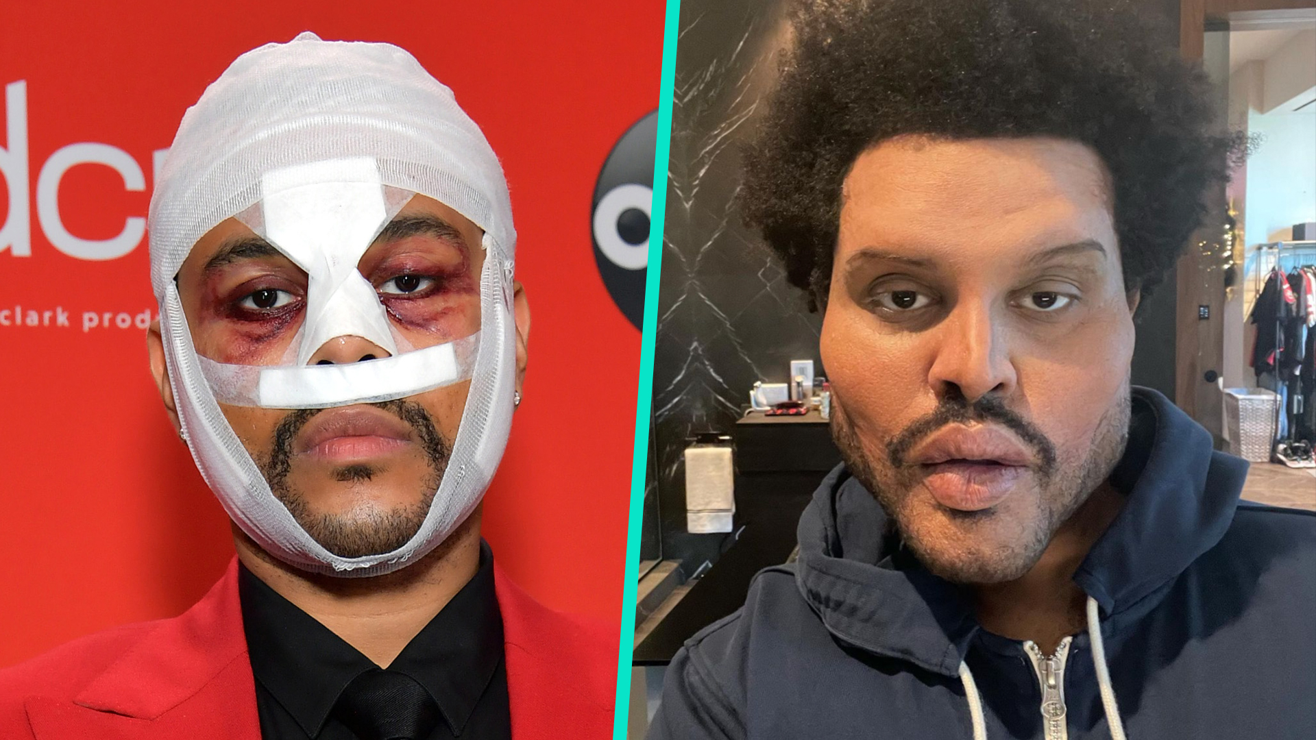 The Weeknd Finally Explains The Meaning Behind His Face Bandages Shocking Transformation