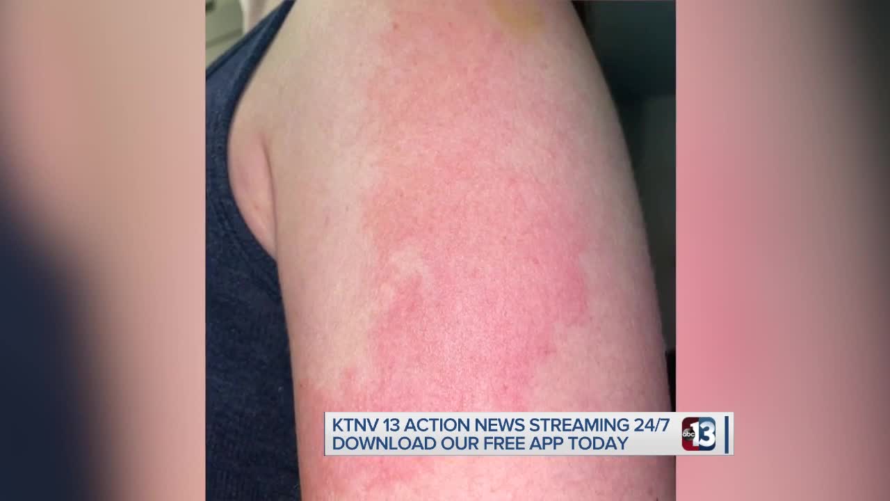 CDC: 'COVID arm' reaction is normal