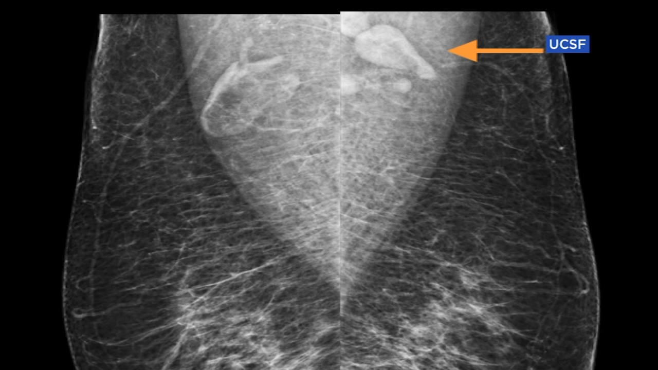 swollen lymph nodes covid