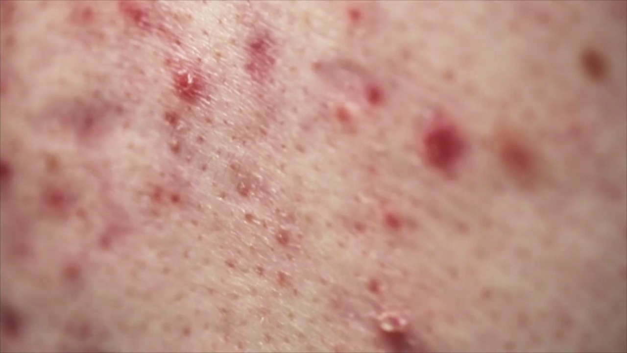 What the Heck Is Skin Purging, Exactly?