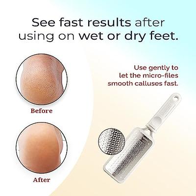 Callus Remover Foot File Stainless Steel Foot Rasp Dead Skin Remover -  Pedicure Foot Scrubber Tools 