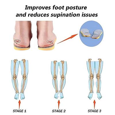 Supination of Foot and Oversupination