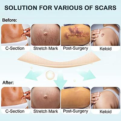 AWD Silicone Scar Tape for Surgical Scars - Medical Grade Silicone Scar  Sheets for C Section, Tummy Tuck Tape, Keloid Treatment - Silicone Skin  Patches After Surgery Must Haves (1.6 x 60