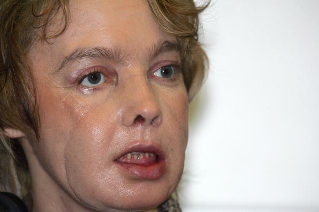 Frenchwoman who received first face transplant dies Part-PAR-Par598851-1-2-0