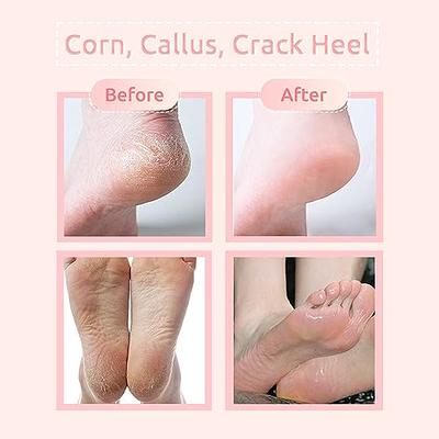 BPrettier Callus Remover for Feet 8.8 OZ Extra Strength Callus Remover Gel  for Hard Calluses Dry Cracked Heels -Foot Care Pedicure at Home (Lavender)  - Yahoo Shopping