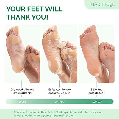 Foot Peel Mask - 3 Pack Foot Mask Dermatologically Tested - Exfoliating  Baby Foot Peel - Repair Heels & Removes Dry Dead Skin - Foot Exfoliator for  Peeling Dry Cracked 