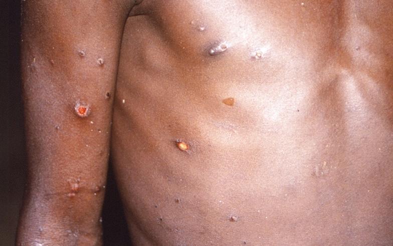 新增一宗猴痘確診個案　男病人曾於新加坡有高風險接觸