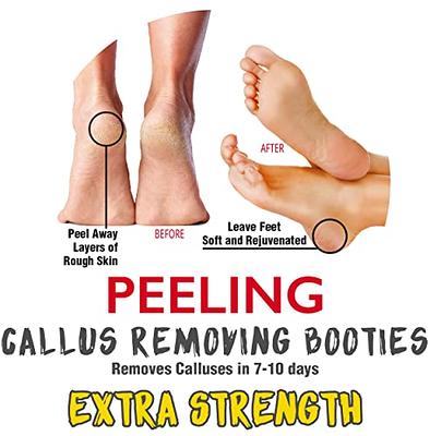 Generic Portable Callus Scraper Cracked Heel Dead Hard Skin Removal | Jumia  Nigeria