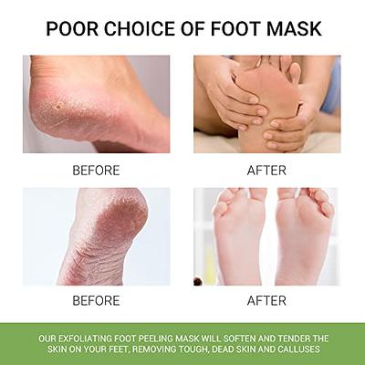 Tea Tree Foot Soak (1 lb) and Foot Peel Mask - Foot Care Kit For Dry  Cracked Feet and Heels - Remove Dead Skin and Calluses - Treats Athlete's  Foot