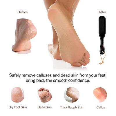 Foot File Foot Rasp Callus Remover - Feet Scraper Tool Exfoliator - Foot  Care Pedicure Grater - Foot Scrubber Dead Hard Skin And Dry Feet - Dry &  Wet Toe Feet Peel 