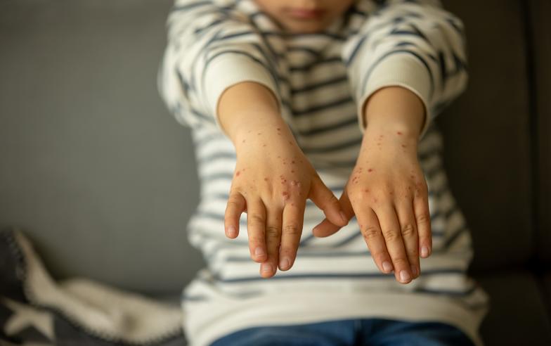 手足口病幼兒個案創 3 年新高　專家教你如何識別病徵　成人亦有機會感染