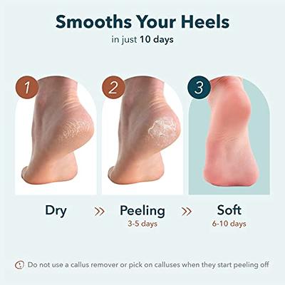 Portable Foot Heel Callus Remover Effectively Removes Dead - Temu