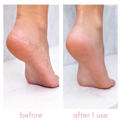 8oz Callus Remover gel for feet for a professional pedicure