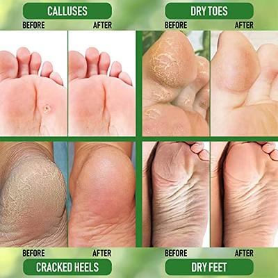 Foot Cure Foot Exfoliator & Callus Remover Pedicure Set Foot Care Kit  Includes Foot File for Dead Skin, Tea Tree Oil Foot Soak Salts, Urea Cream  40 Percent & Foot Callus Removal