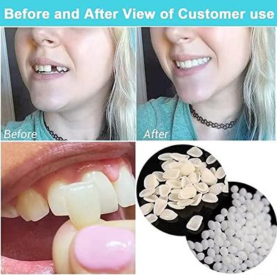 Temporary Tooth Repair Kit, Moldable Fake Teeth, Moldable False Teeth  Thermal Fitting Beads for Cosplay - Yahoo Shopping