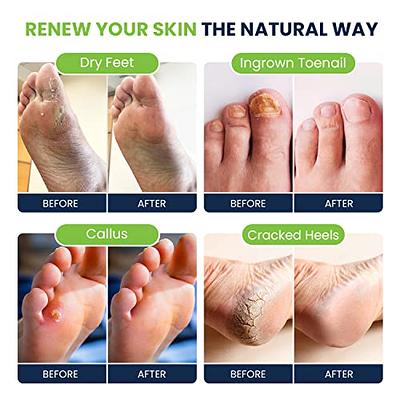 Foot Cure Callus Remover Gel Kit with Tea Tree Oil Foot Soak