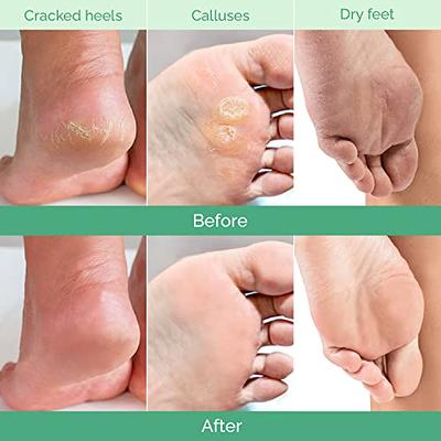 Foot Peel Mask - 3 Pack Foot Mask Dermatologically Tested - Exfoliating  Baby Foot Peel - Repair Heels & Removes Dry Dead Skin - Foot Exfoliator for  Peeling Dry Cracked 