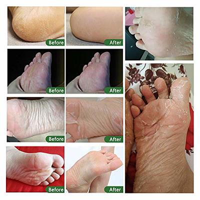 Baby Foot Peel treatment, removing callouses : r/popping